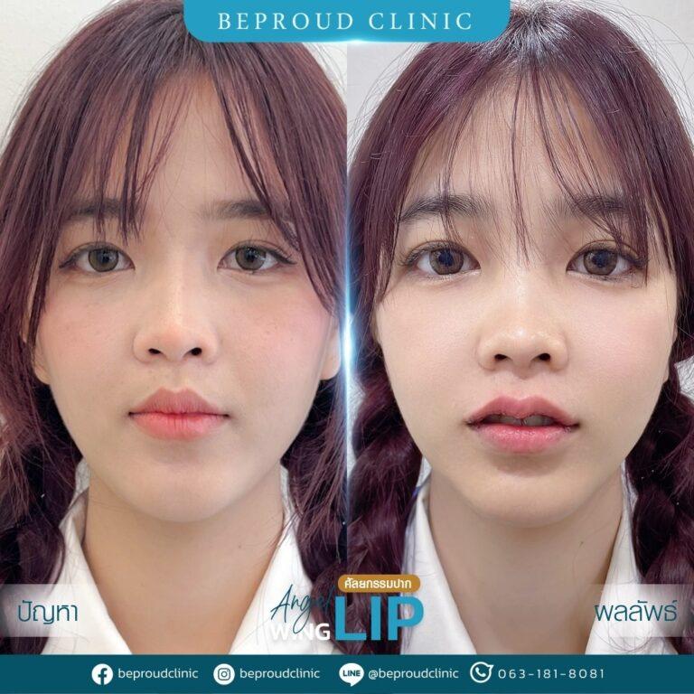 รีวิวแก้ปัญหาปากหนา ปากใหญ่ เนื้อปากเยอะ