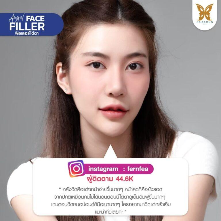 Filler Beproud Clinic