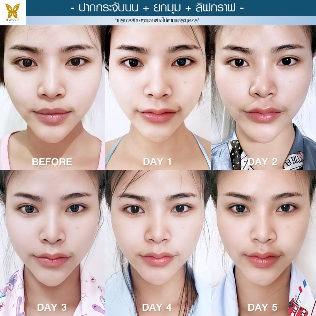 ปากกระจับ ยกมุม ลิฟกราฟ