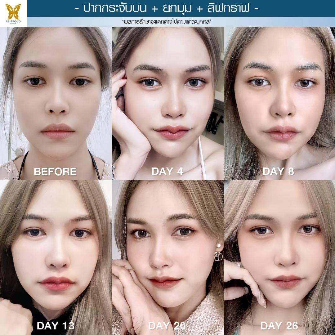 ปากกระจับ ยกมุม ลิฟกราฟ