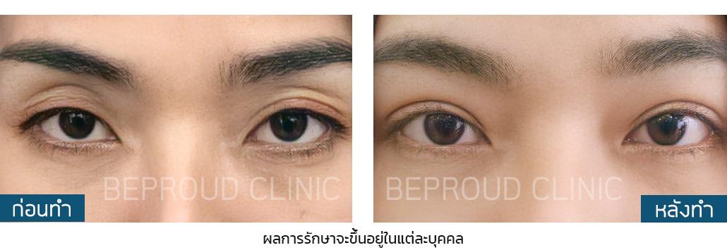 เผย "6 เทคนิคทำตาสองชั้น" ตาของเราเหมาะสมกับเทคนิคแบบไหน?