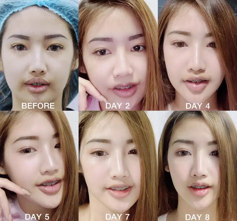 ดัดฟันทำปากกระจับ