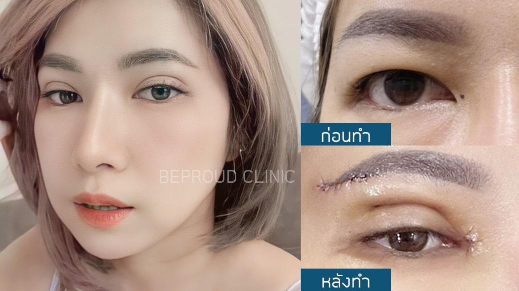 เผย "6 เทคนิคทำตาสองชั้น" ตาของเราเหมาะสมกับเทคนิคแบบไหน?