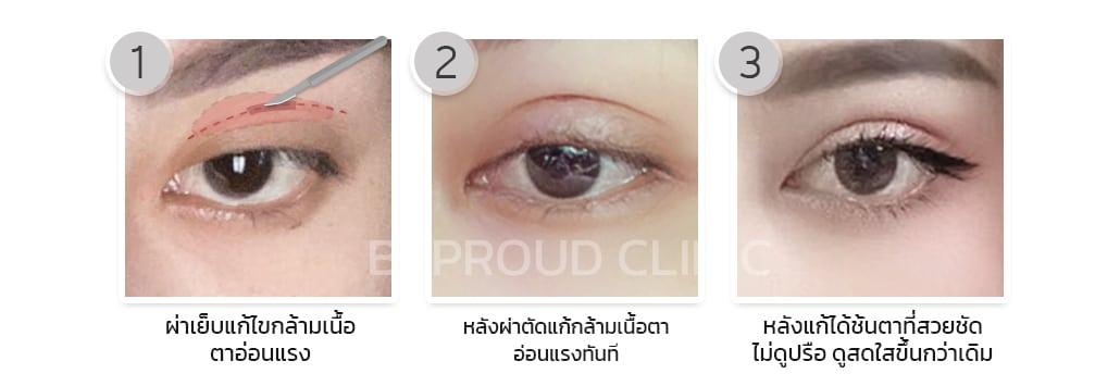 เผย "6 เทคนิคทำตาสองชั้น" ตาของเราเหมาะสมกับเทคนิคแบบไหน?