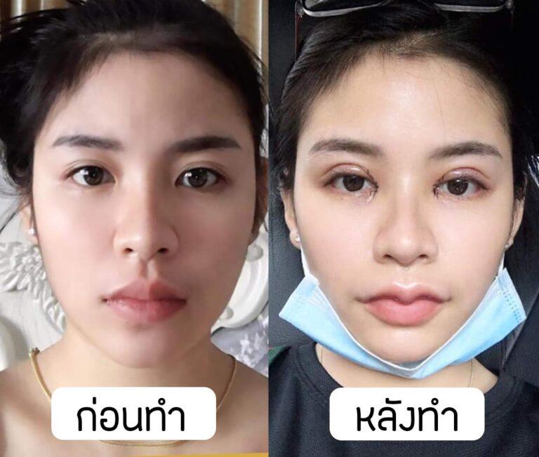 แชร์ประสบการณ์ ทำปากกระจับ ตาสองชั้น