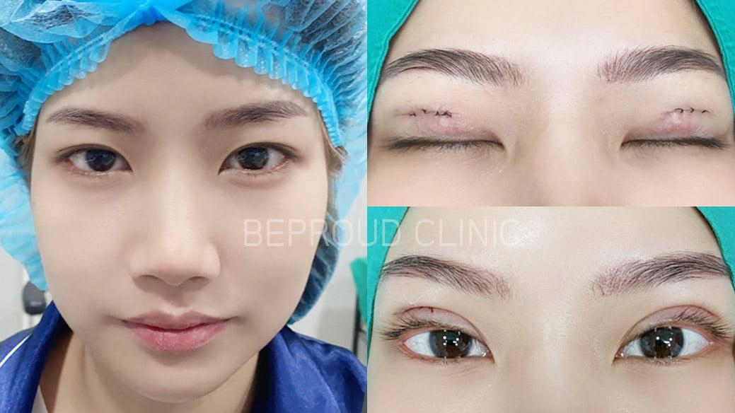 ระยะบวมช้ำหลังทำตา ด้วย”เทคนิค Mini Angel stitch”