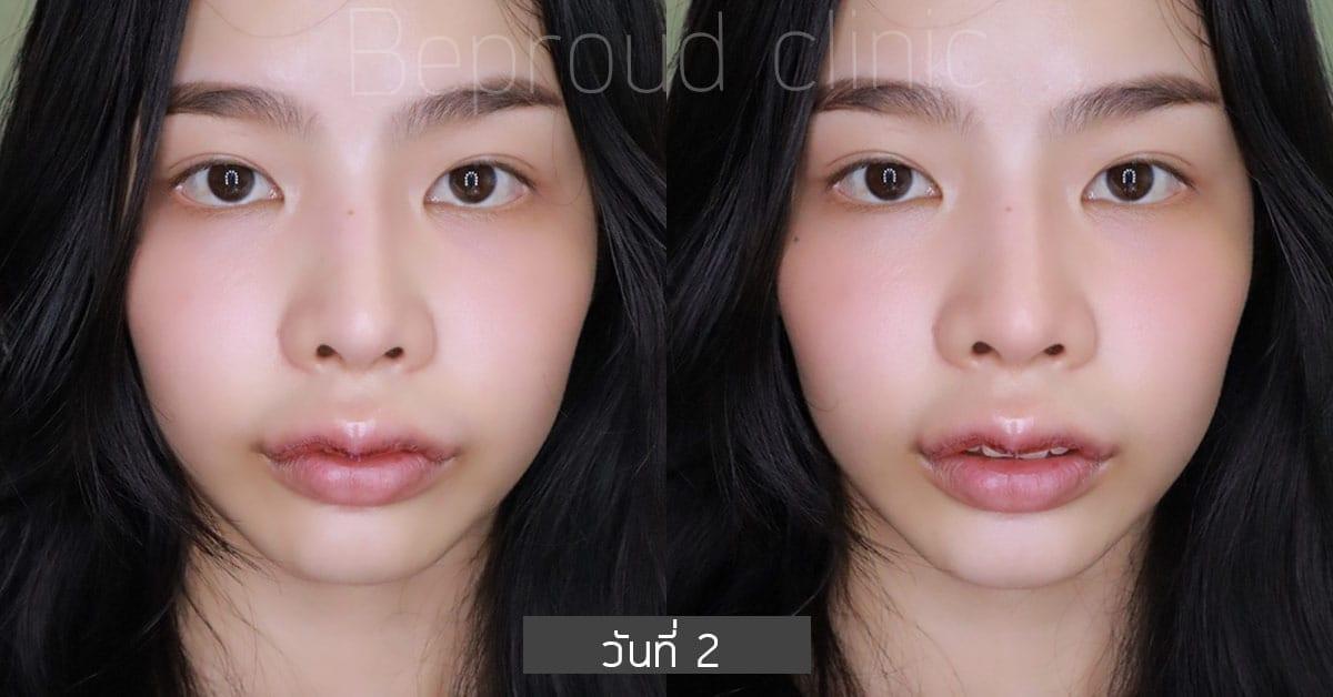 รีวิวปากกระจับปีกนางฟ้า บีพราวด์