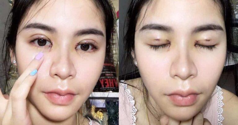แชร์ประสบการณ์ ทำปากกระจับ ตาสองชั้น