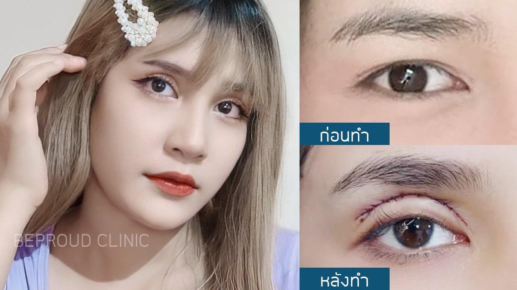 เทคนิคกรีดตายาว