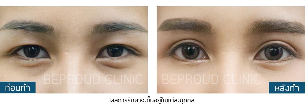 เผย "6 เทคนิคทำตาสองชั้น" ตาของเราเหมาะสมกับเทคนิคแบบไหน?