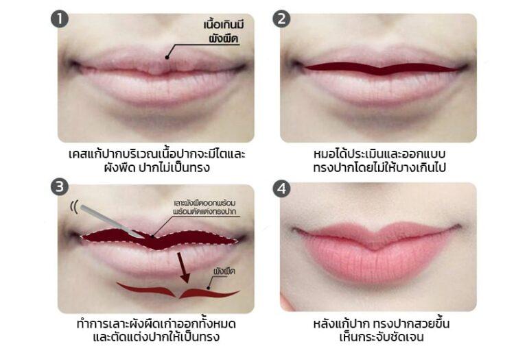 ขั้นตอนการแก้ปากกระจับ