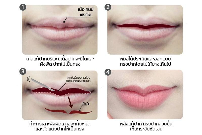 ขั้นตอนการแก้ปากกระจับ