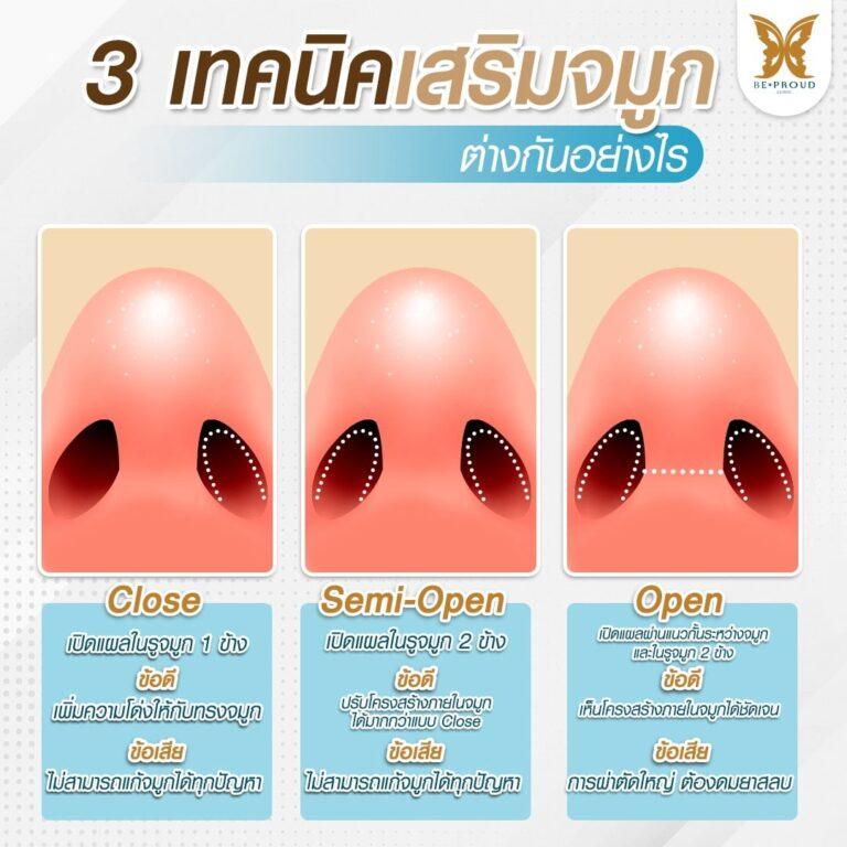 เทคนิคการเสริมจมูกแบบเปิด (Open Rhinoplasty)