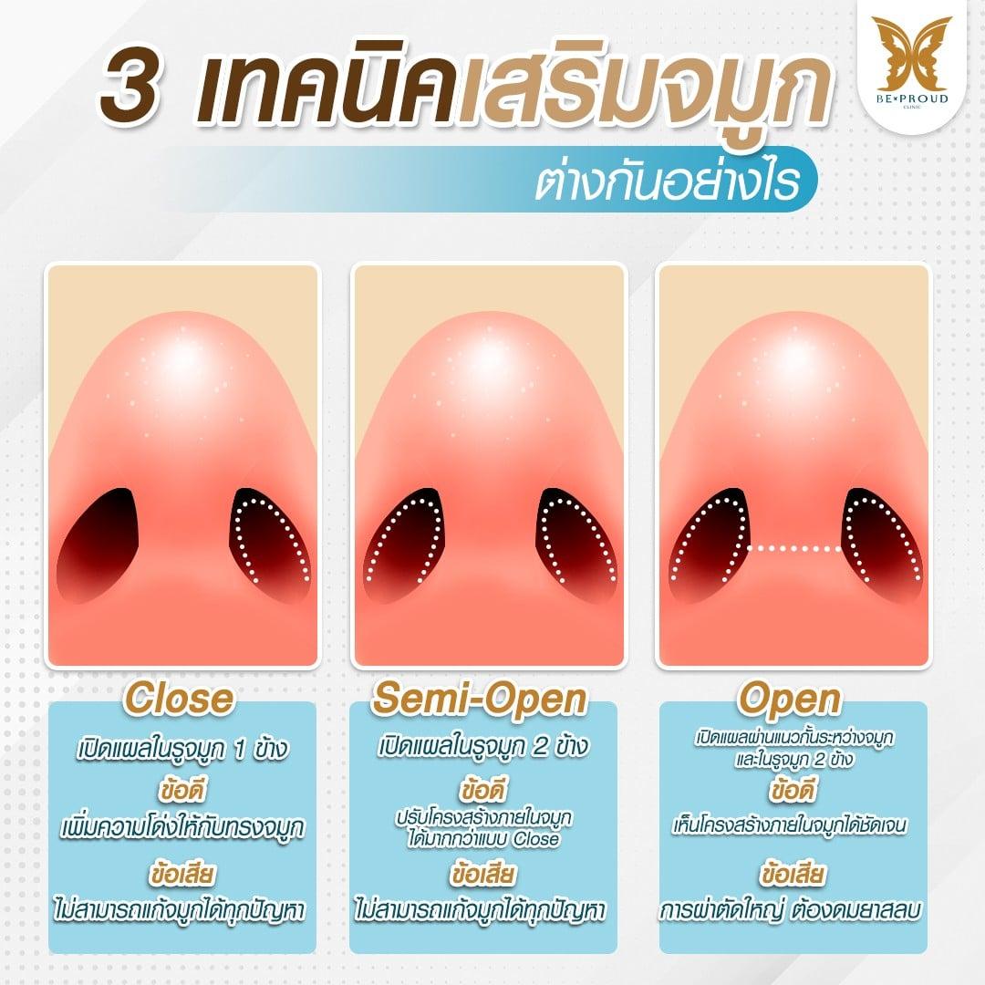 เทคนิคการเสริมจมูกแบบเปิด (Open Rhinoplasty)