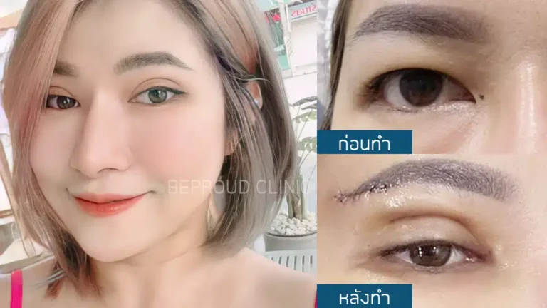 เทคนิคการผ่าตัดยกหางตาแผลใต้คิ้ว
