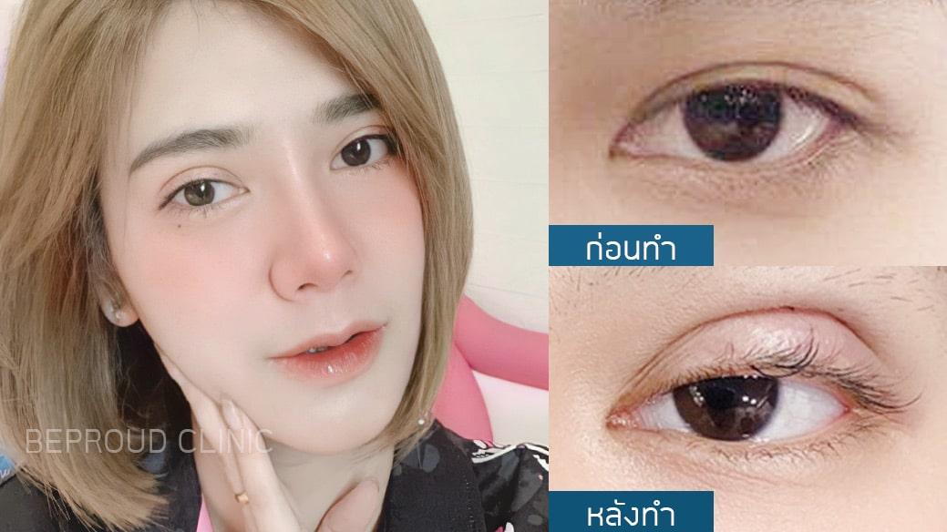 เทคนิคกรีดตายาวแผลมินิ