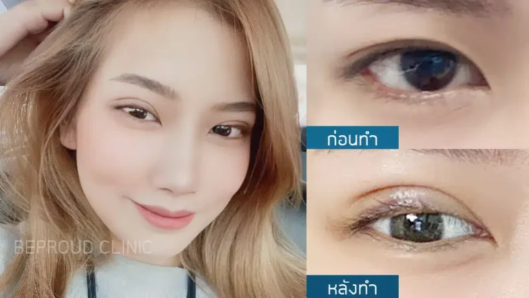 เทคนิคกรีดตายาวแผลมินิ