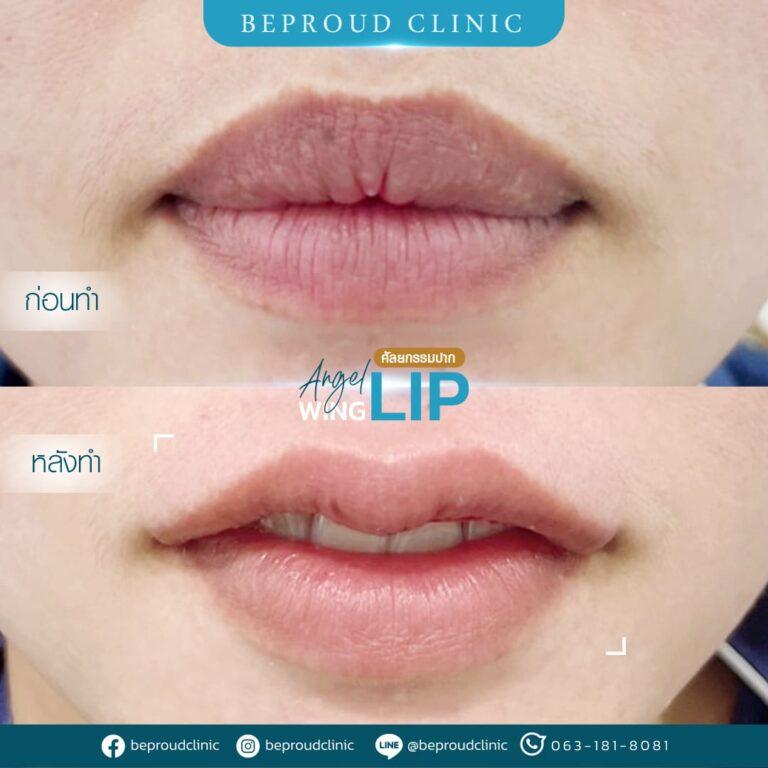 รีวิวตัดปากกระจับ แก้รูปปากไม่สมดุล