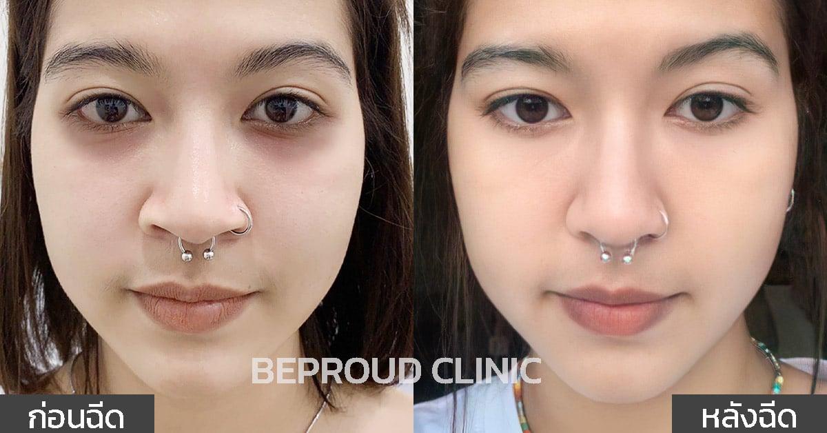 ฉีดฟิลเลอร์ บีพราวด์