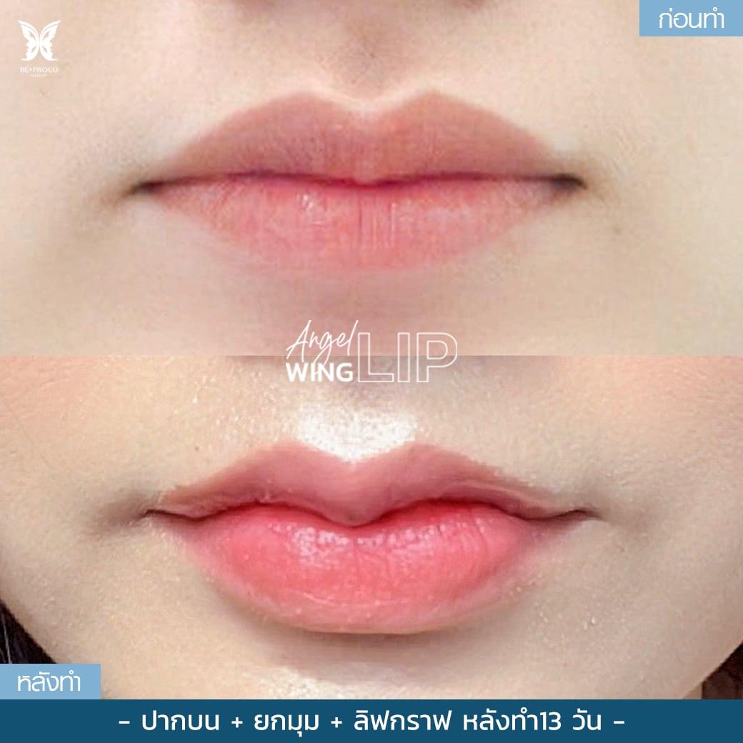 ศัลยกรรมปากกระจับ เพิ่มความคมชัดเส้นขอบปาก