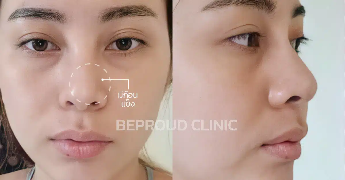 เคสขูดสารเหลวในจมูก