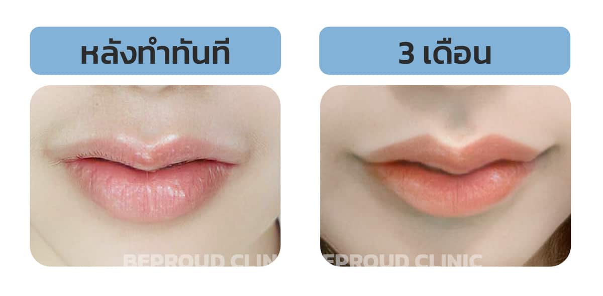ชปากคลายตัวหลังทำ 3 เดือน