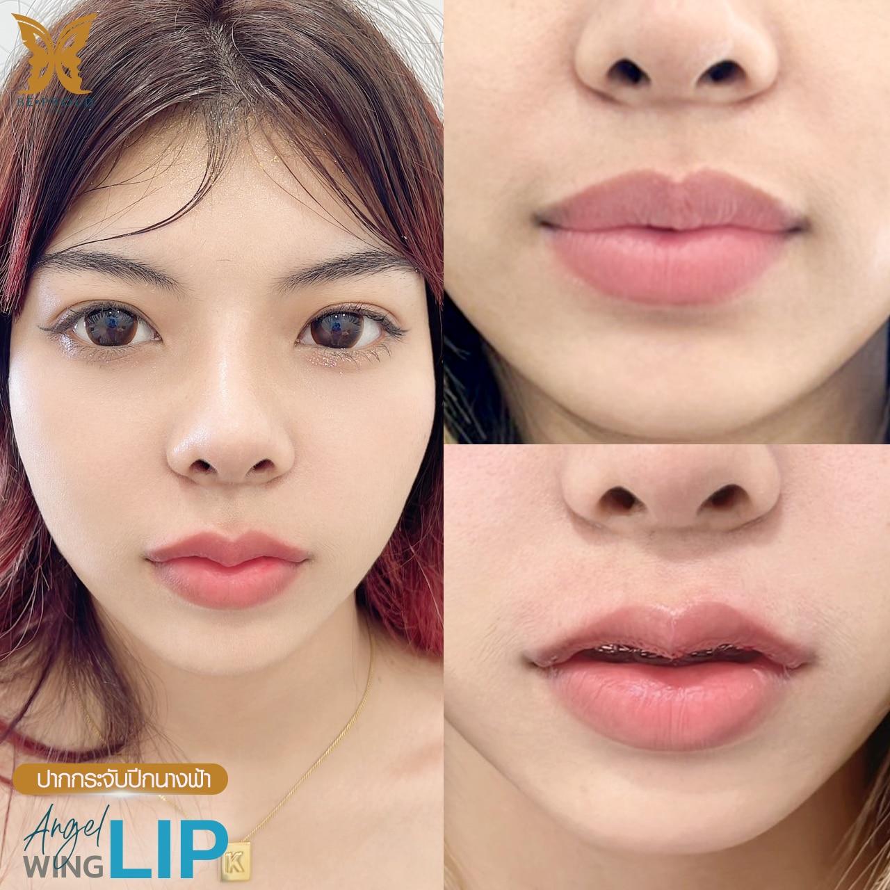 ศัลยกรรมปากกระจับ