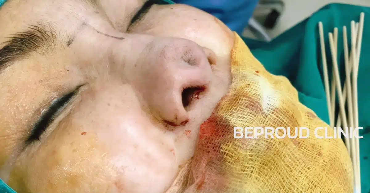 เคสจมูกติดเชื้อ