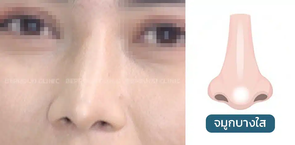 เช็คอาการ!! ก่อนซิลิโคนจมูกทะลุ ผิวจมูกบางใส
