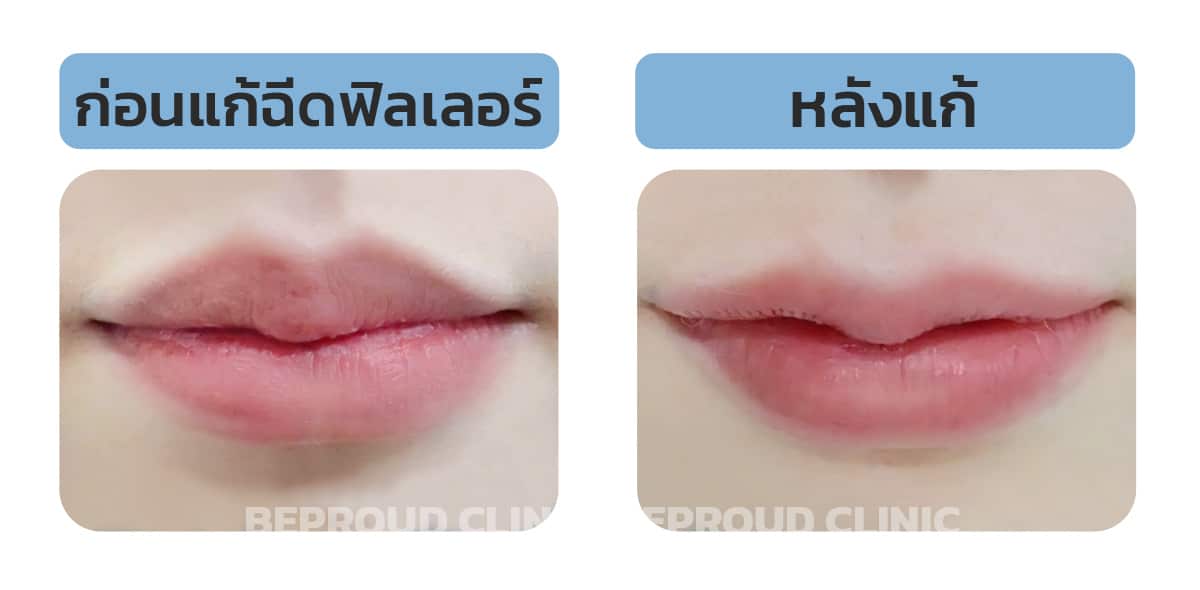 ผลลัพธ์หลังแก้ฟิลเลอร์ปาก