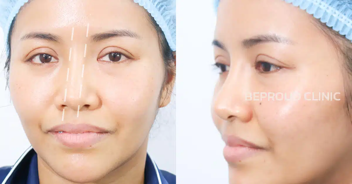 เคสซิลิโคนจมูกเอียง