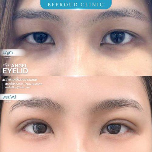 หนังตาตกทำไงดี? แก้ไขปัญหาตาปรือและเพิ่มความมั่นใจ