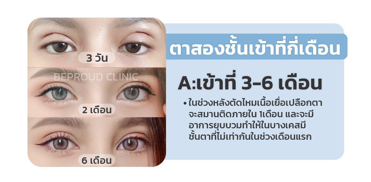 ตาสองชั้นเข้าที่ประมาณกี่เดือน