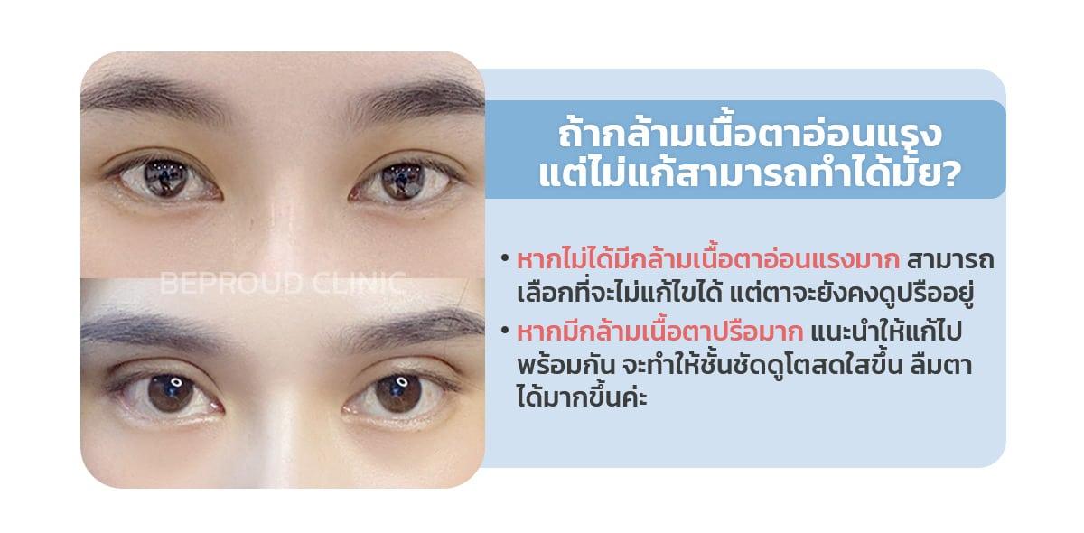 มีกล้ามเนื้อตาอ่อนแรง ไม่แก้สามารถทำได้มั้ย