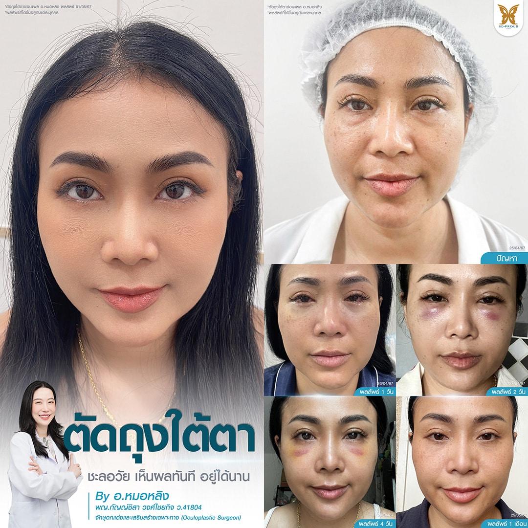 ข้อดีศัลยกรรมตาสองชั้นผู้สูงอายุ