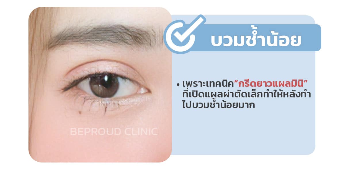 หลังทำตาจะบวมช้ำเยอะมั้ย