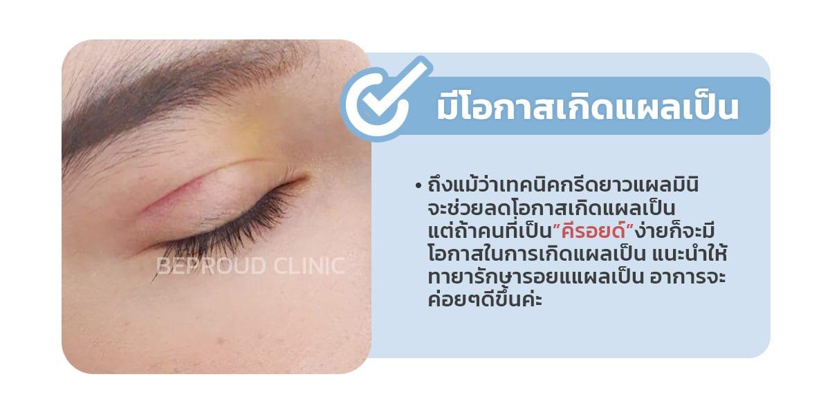หลังทำตาสองชั้นจะเป็นแผลเป็นมั้ย