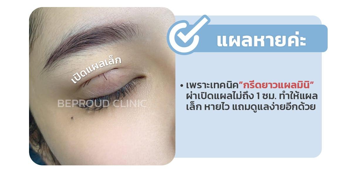 หลังทำตาสองชั้น แผลหลังทำจะหายมั้ย