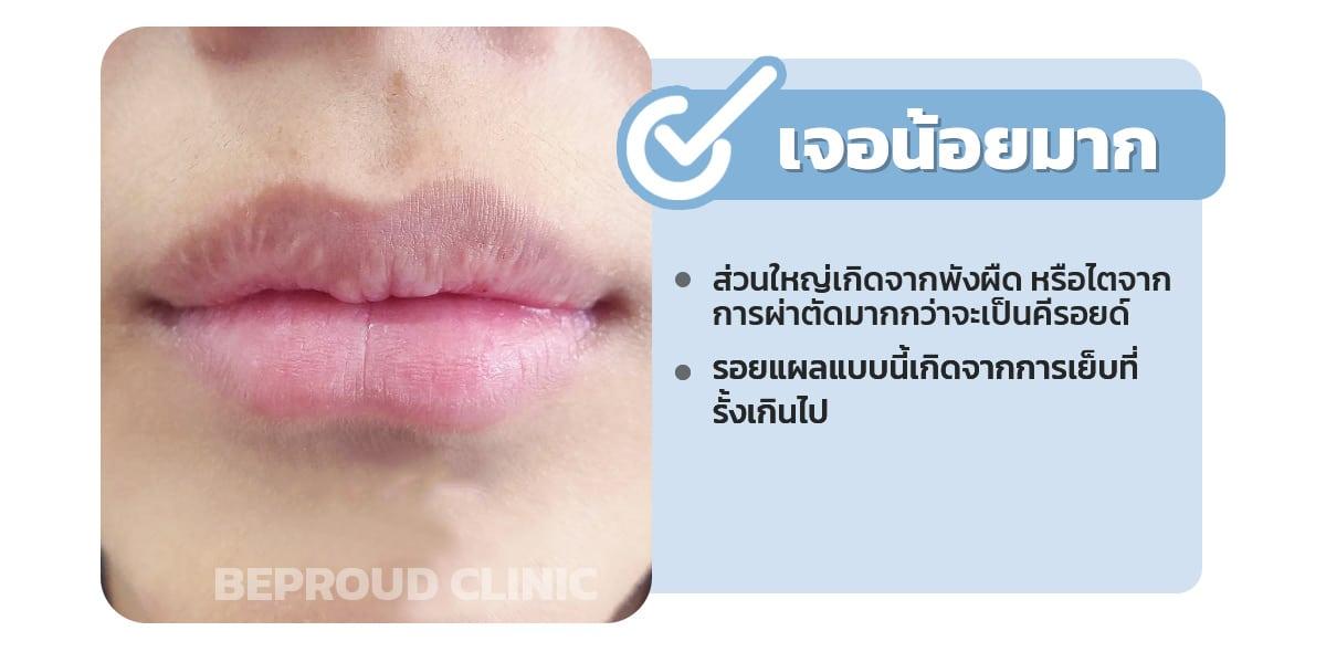ทำปากกระจับ คีลอยด์ที่ปากเจอน้อยมาก