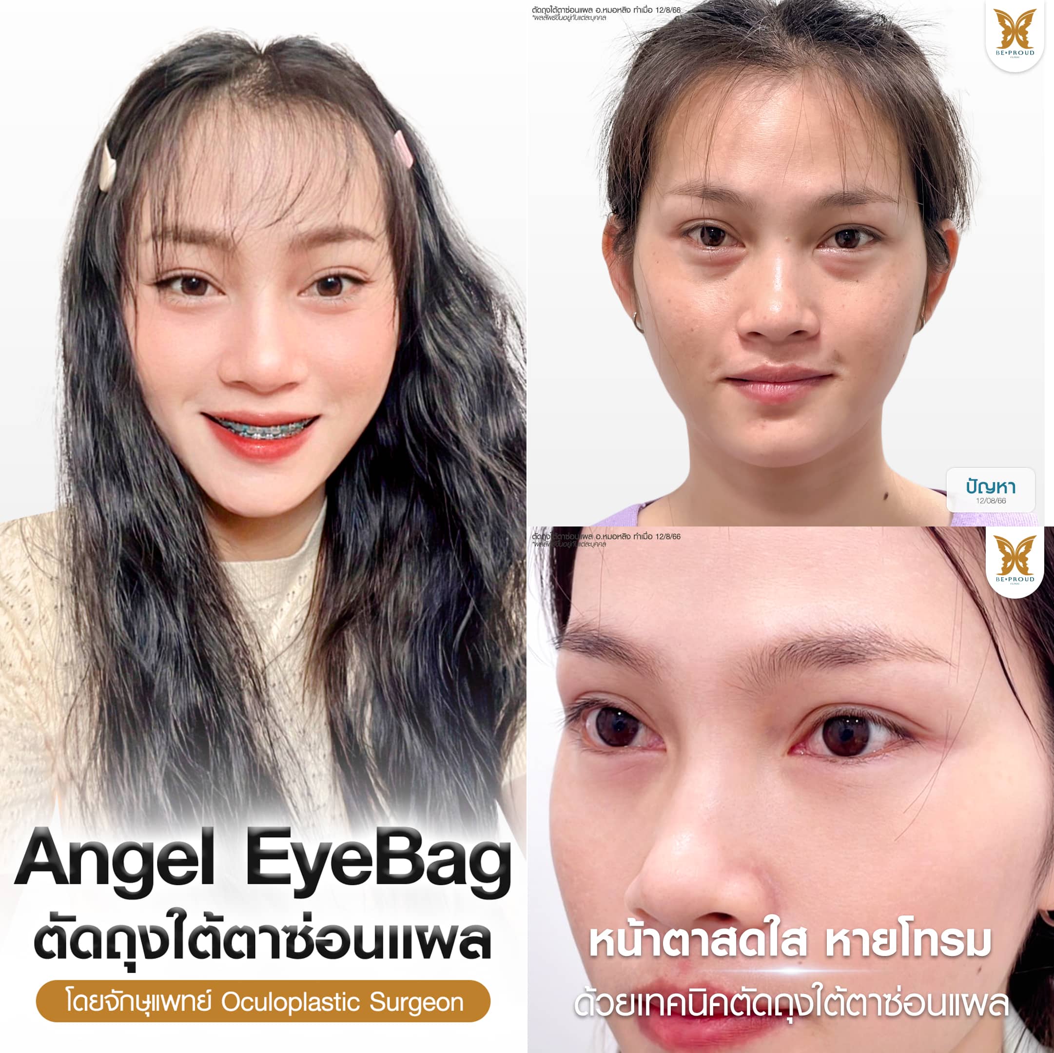 ตัดถุงใต้ตา Beproud Clinic