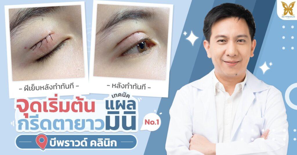 จุดเริ่มต้นเทคนิคตาสองชั้น กรีดตายาวแผลมินิ