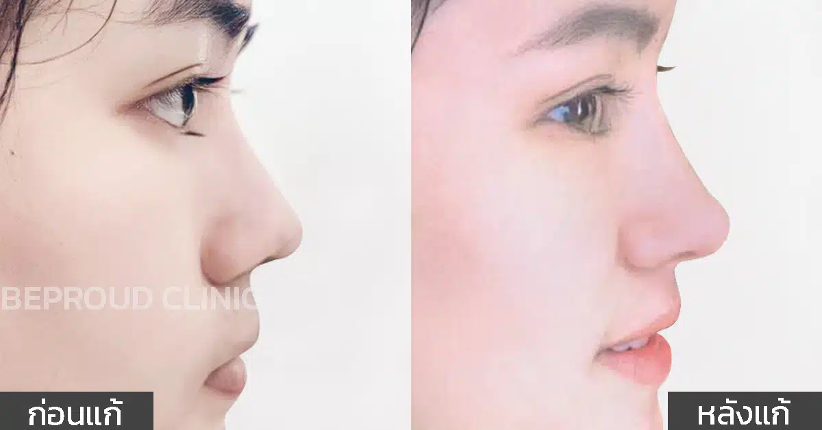 เคสปรับทรงจมูก
