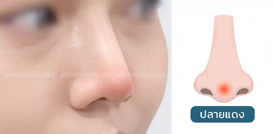 เช็คอาการ!! ก่อนซิลิโคนจมูกทะลุ ปลายจมูกแดง