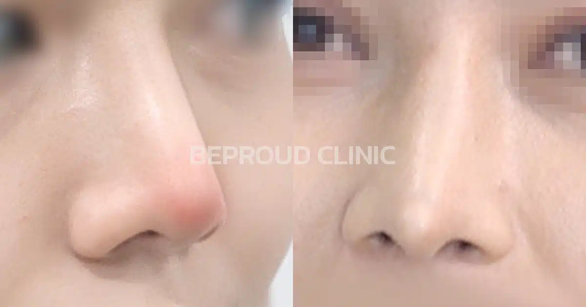 เคสปลายจมูกแดง ผิวบางใส เสี่ยงทะลุ