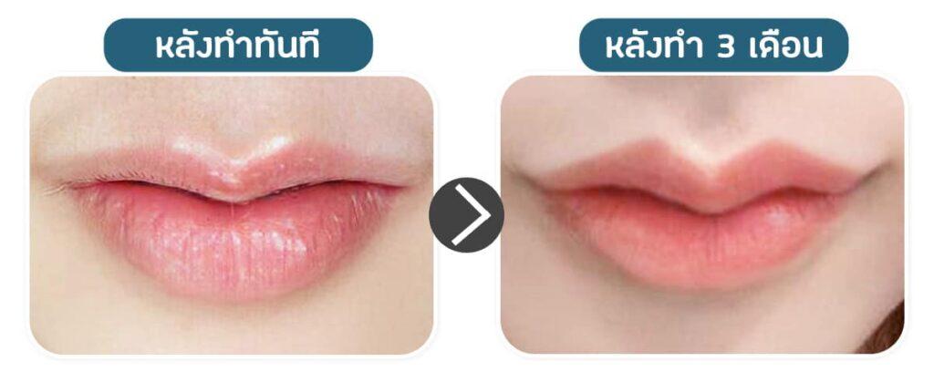 หลังทำปากกระจับ ปากจะคลายตัวมั้ย