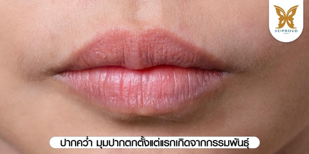 ปากคว่ำ มุมปากตกตั้งแต่แรกเกิดจากกรรมพันธุ์ 