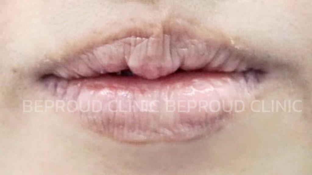 ลักษณะเนื้อปากยุ่ย