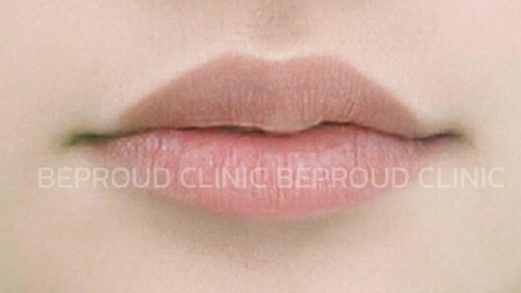 การดูแลปากกระจับหลังทำไปไม่ดี