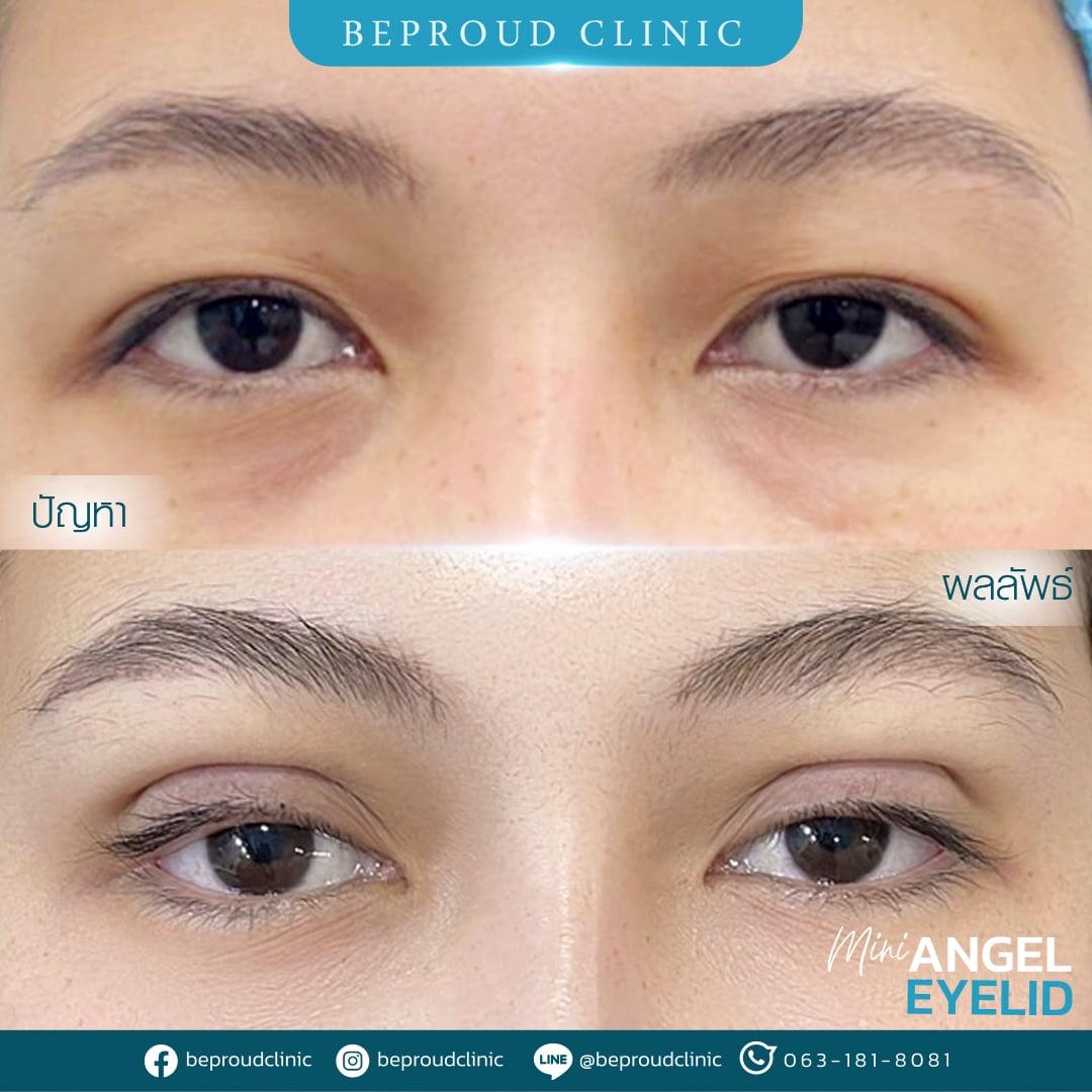 หนังตาตกทำไงดี? แก้ไขปัญหาตาปรือและเพิ่มความมั่นใจ