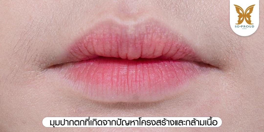 มุมปากตกที่เกิดจากปัญหาโครงสร้างและกล้ามเนื้อ